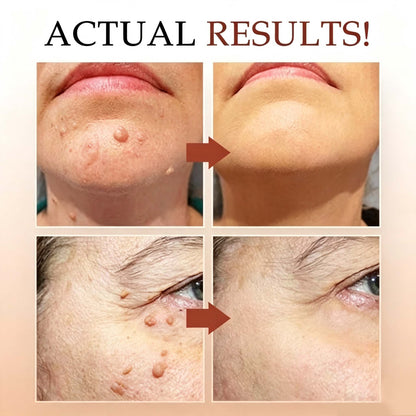 LAST DAY 49% OFF Tags & Moles Remover
